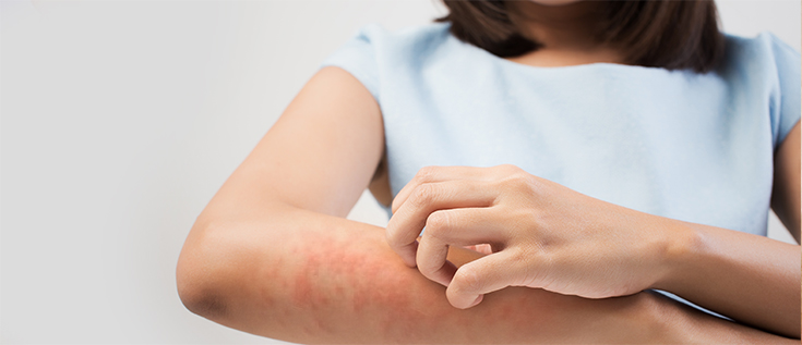 اگزما چیست و درمان قطعی آن